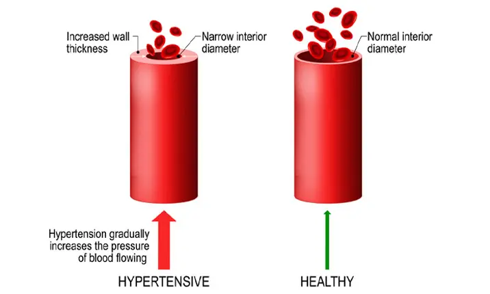 What is normal store high blood pressure