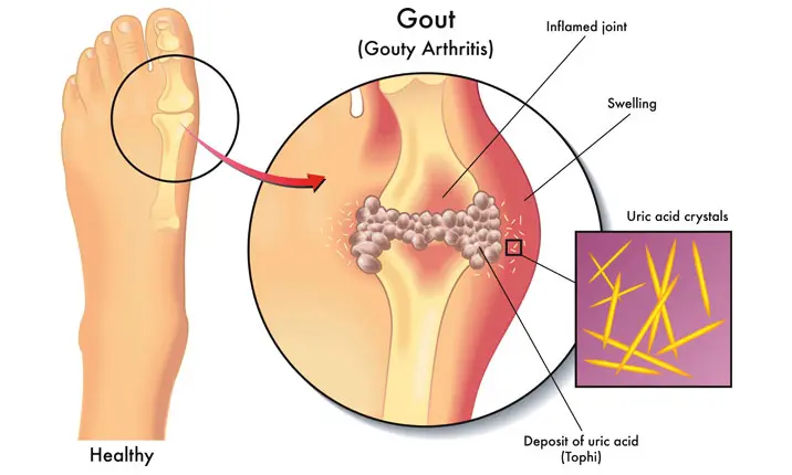 Urine Uric Acid Test Strip (Gout) - Home Health Europe