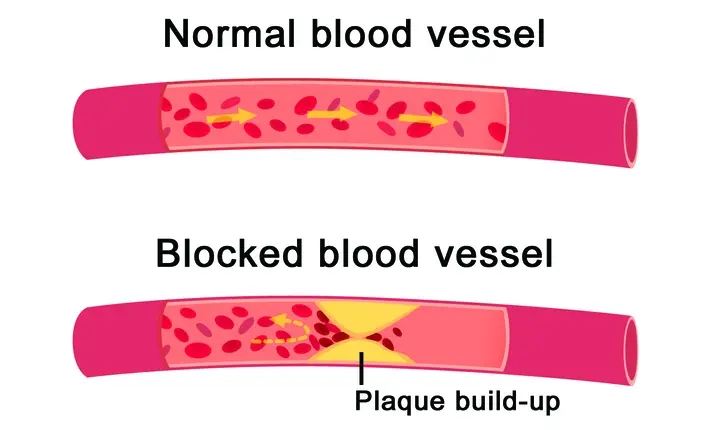 Stents for blocked arteries
