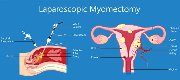 Ovarian Cysts During Pregnancy 