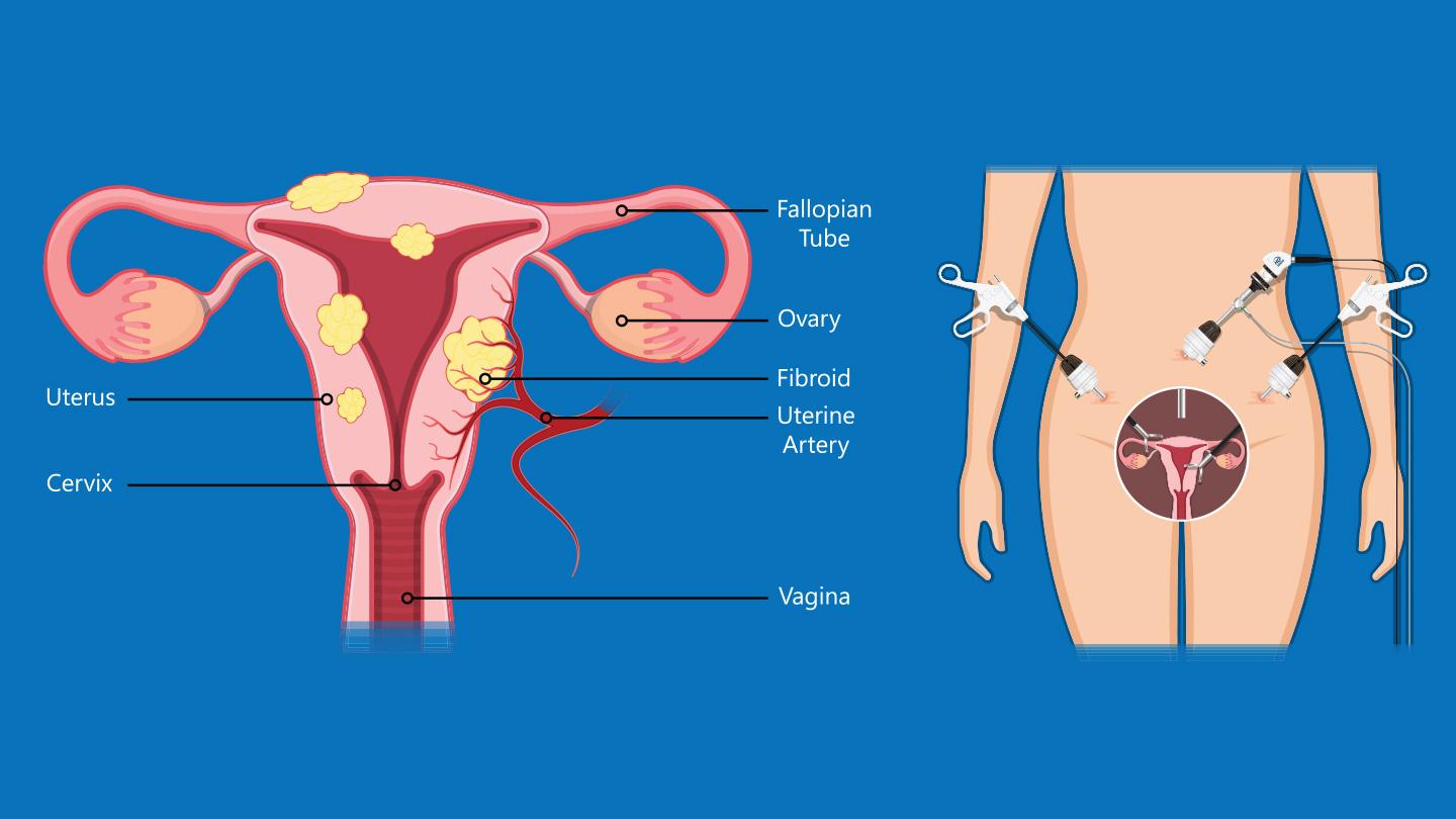 Myomectomy Fibroid Removal Mount Elizabeth Hospitals