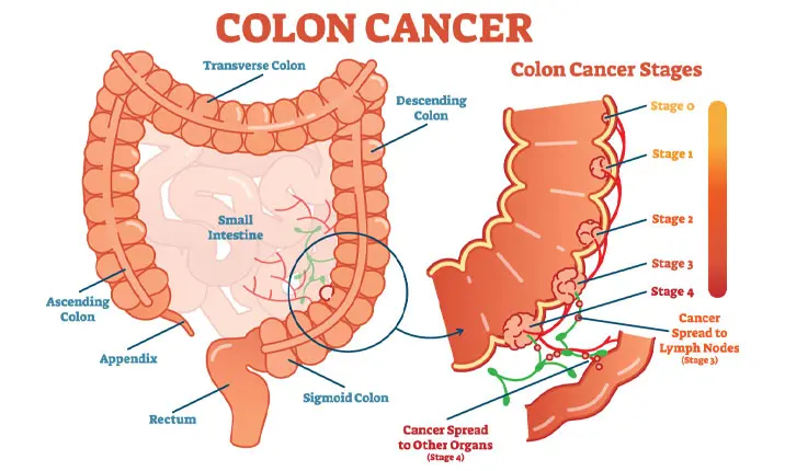 Hormones Responsible For Some Men's Long Legs May Up Their Colorectal  Cancer Risk