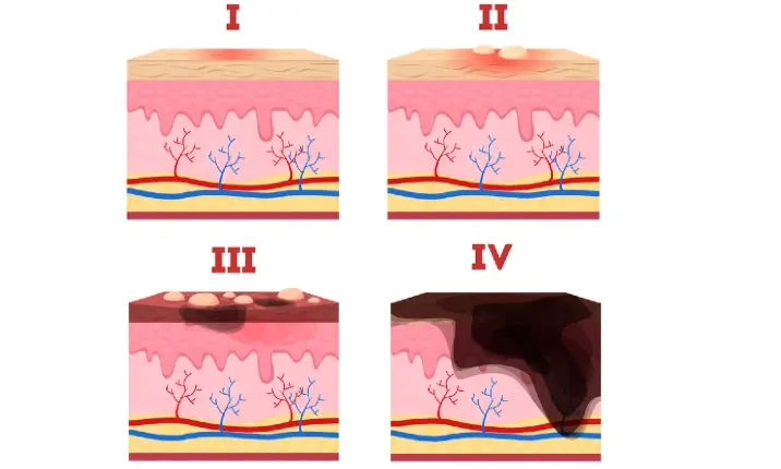 Treating Minor Burns and Scalds