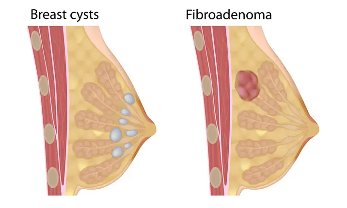 Breast lump Information