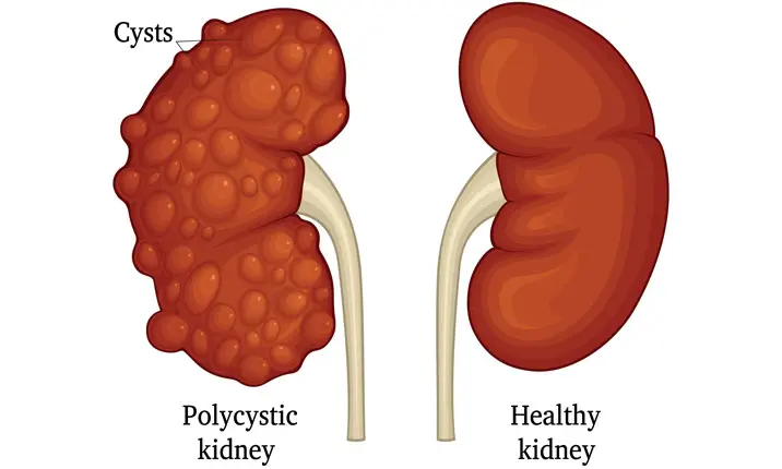 Kidney disease polycystic kidney