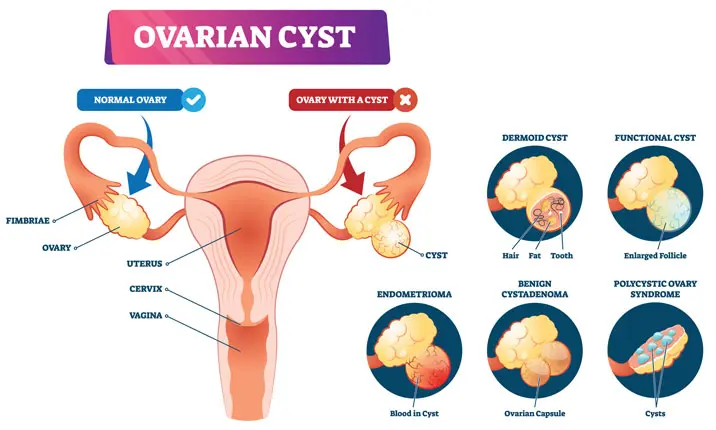 Laparoscopic resection of a torted ovarian dermoid cyst