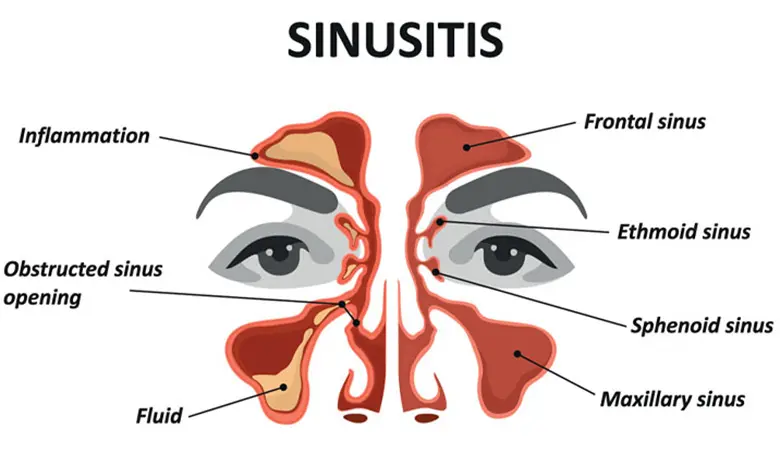 Sinusitis is a disease characterised by inflammation of the tissue lining the sinuses.