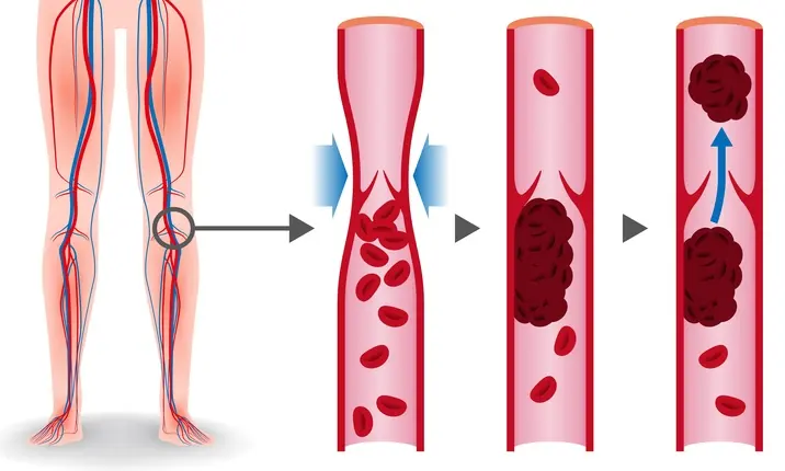 Endovascular surgery - Deep vein thrombosis