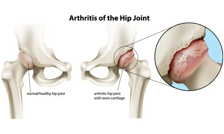 Hip arthritis types
