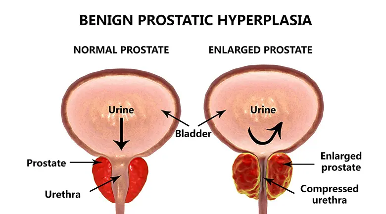 Tăng Sản Lành Tính Tuyến Tiền Liệt (BPH) Là Gì?