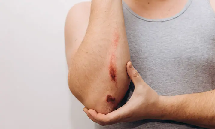 Cuts and abrasions