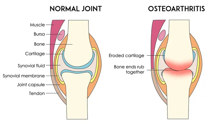 Knee (Articular) Cartilage Damage: Causes & Treatment