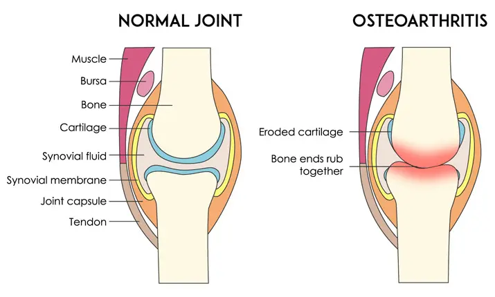 Knee shop cartilage pain