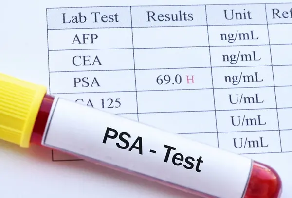 Prostate test - PSA test
