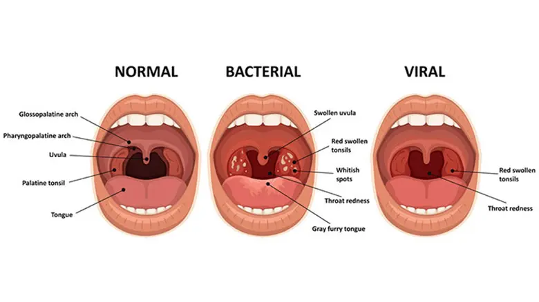 normal tonsils vs infected tonsils