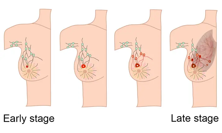 Breast Cancer Screening in Singapore