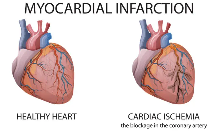 Is your blood pressure high deals when having a heart attack