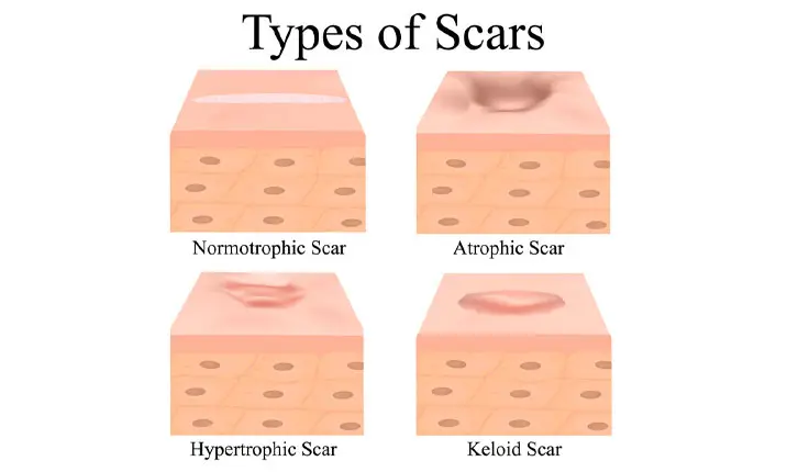 Scar types