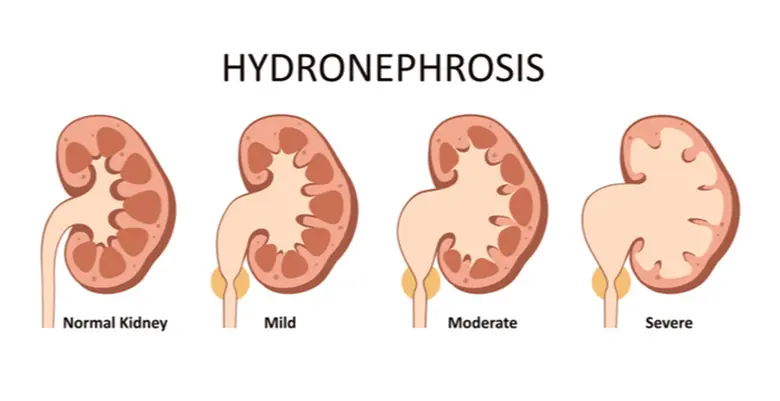 Hydronephrosis is the swelling of the kidney due to blockage or backflow in the urinary tract.