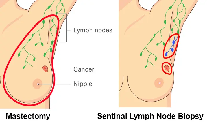 Breast cancer treatment - Sentinel lymph node biopsy
