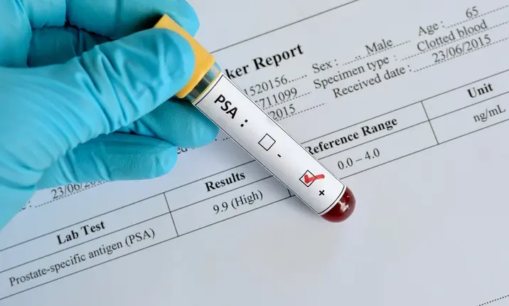 PSA test prostate cancer