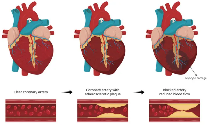 Coronary artery cardiovascular disease