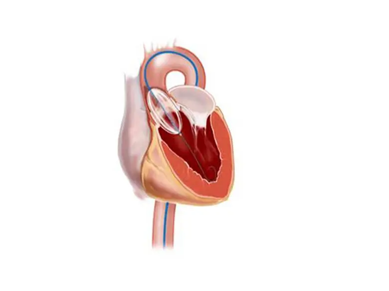 inflatable-balloon-is-inserted-into-aorta.tmb-210x133