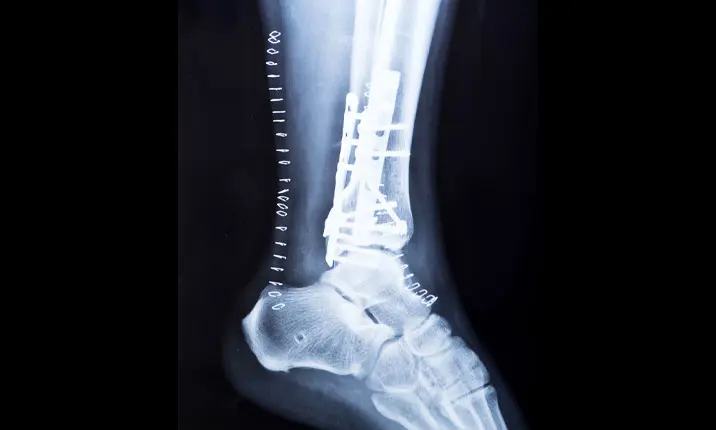 Ankle Fractures In Children - OrthoInfo - AAOS