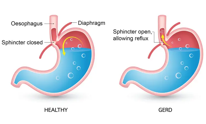 Gastric problems causing chest pain - GERD