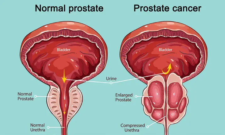 Surgery for prostate cancer - Prostate cancer
