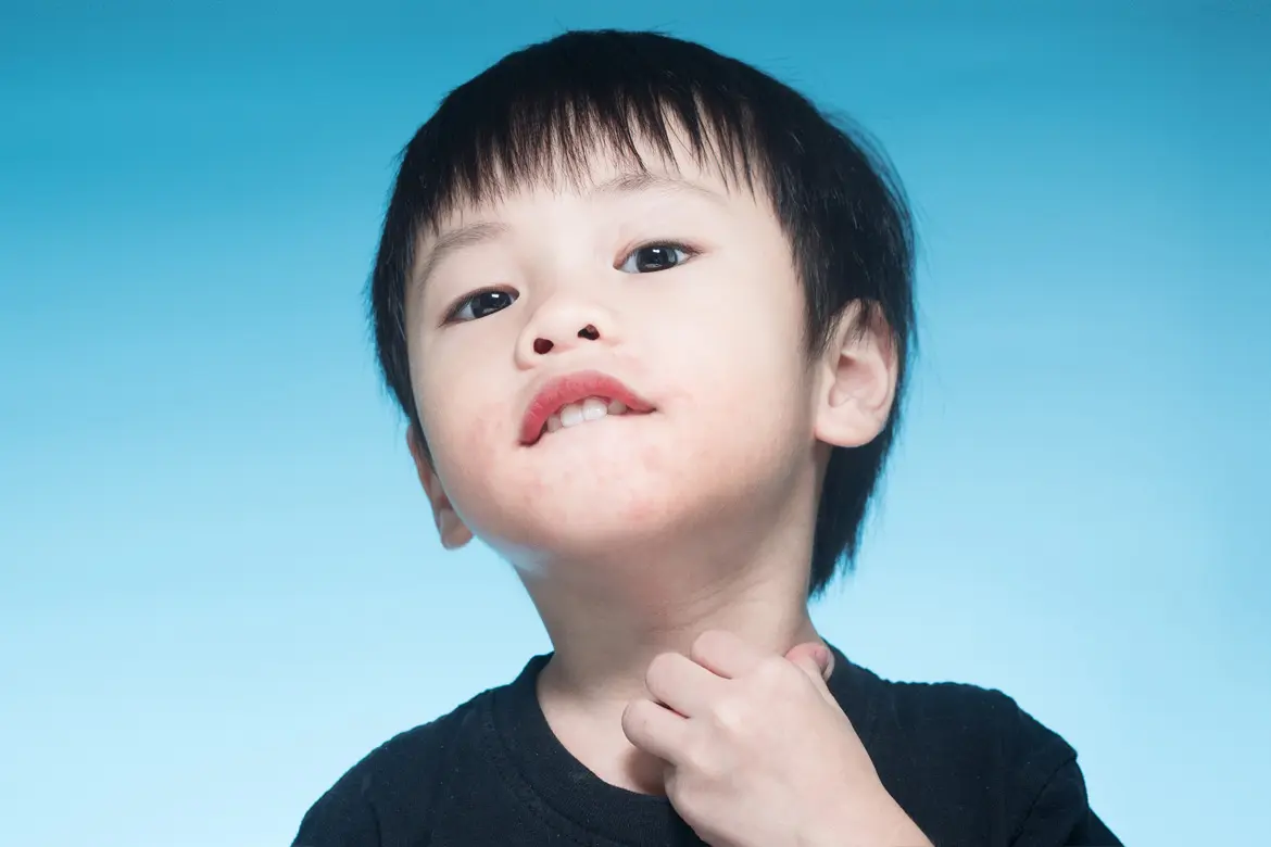 Có Khỏi Được Bệnh Dị Ứng Thực Phẩm Không?
