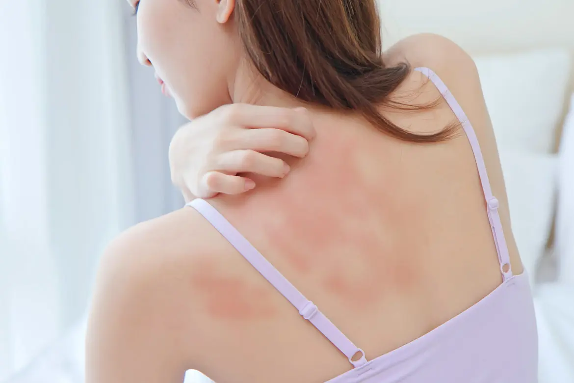 9 Things You Didn't Know about Adult Eczema