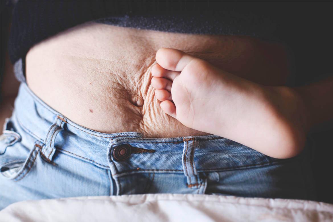 Diastasis Recti: A Medical Condition That Should Not Be Ignored