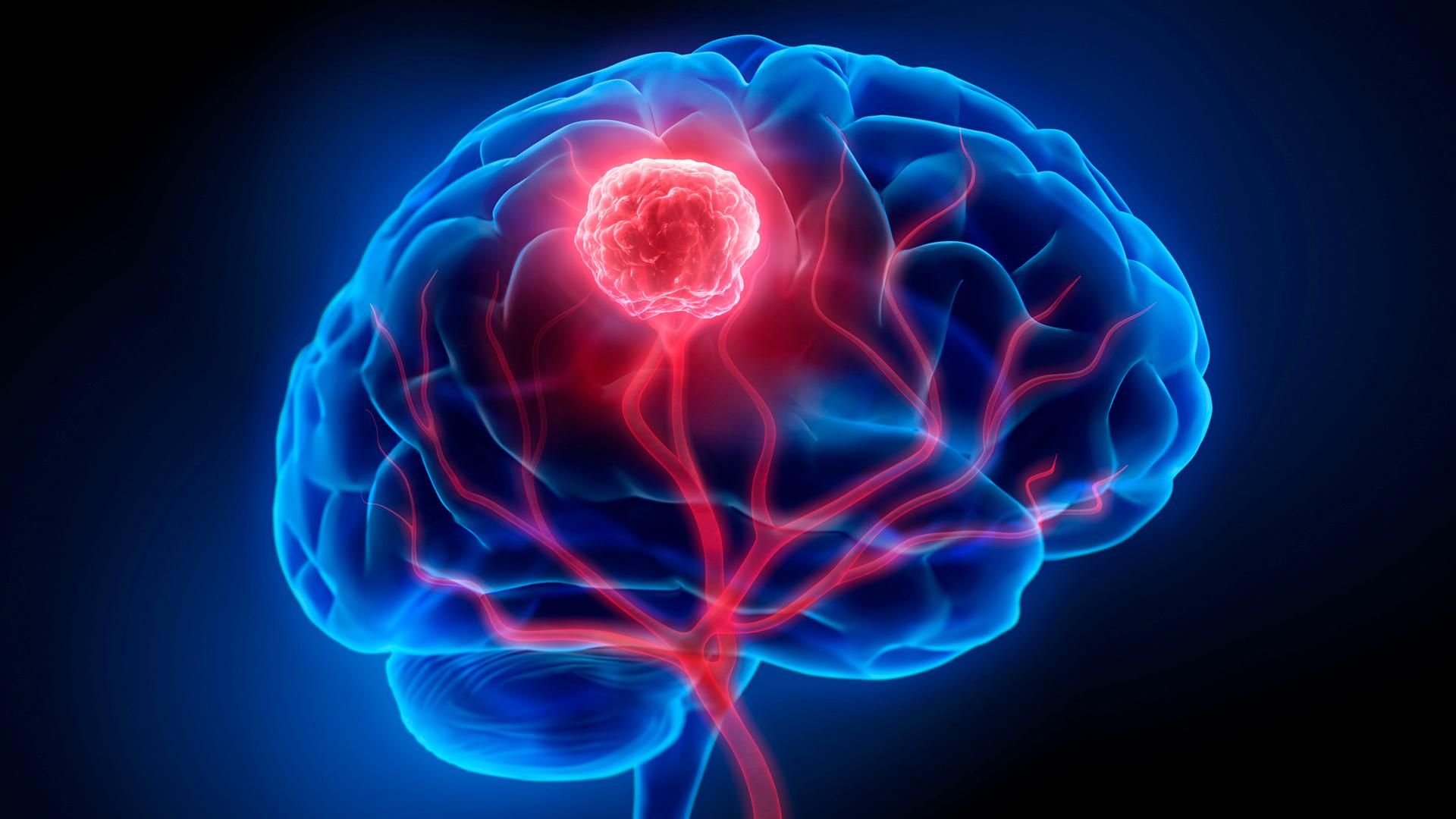 Brain and Nerve Tumours