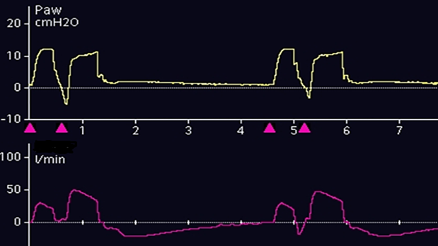 Screenshot of flow and pressure waveform showing double triggering