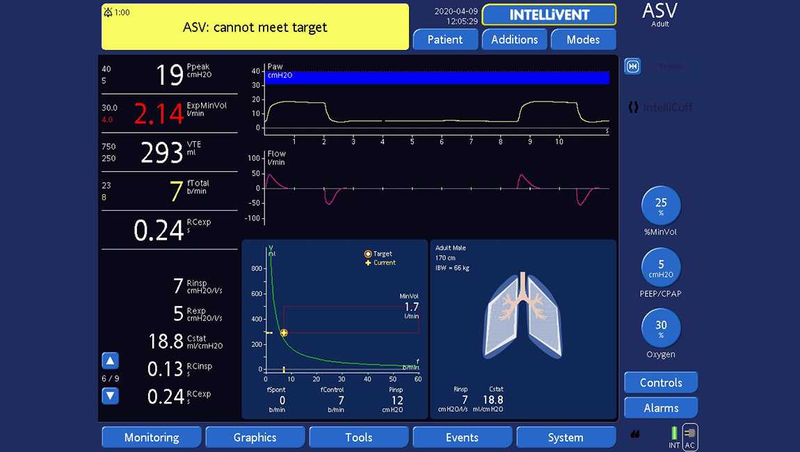 Screen showing ventilator display with low-priority alarm ASV cannot meet target