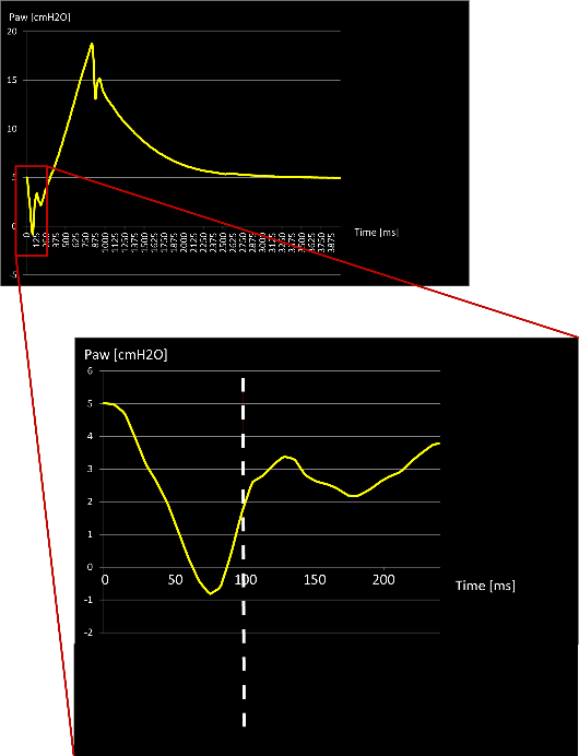 Screenshot of ventilator display showing pressure drop
