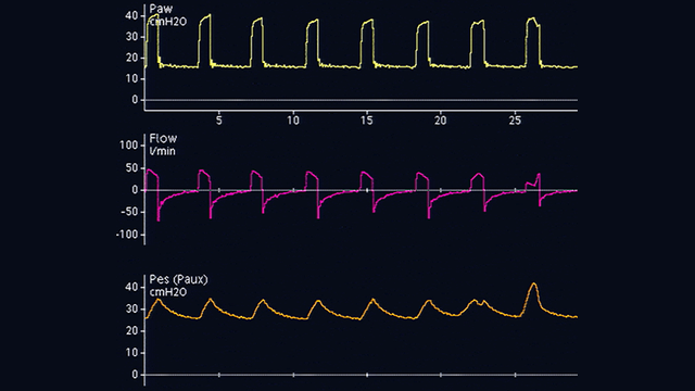 Waveform showing baseline for gastric pressure