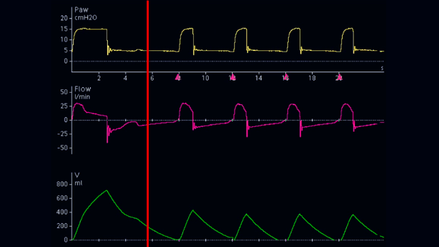 Screenshot of flow waveform when ETS increased
