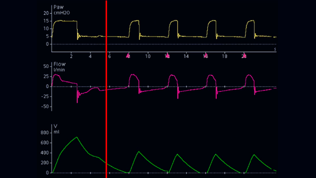 Screenshot of flow waveform when ETS increased