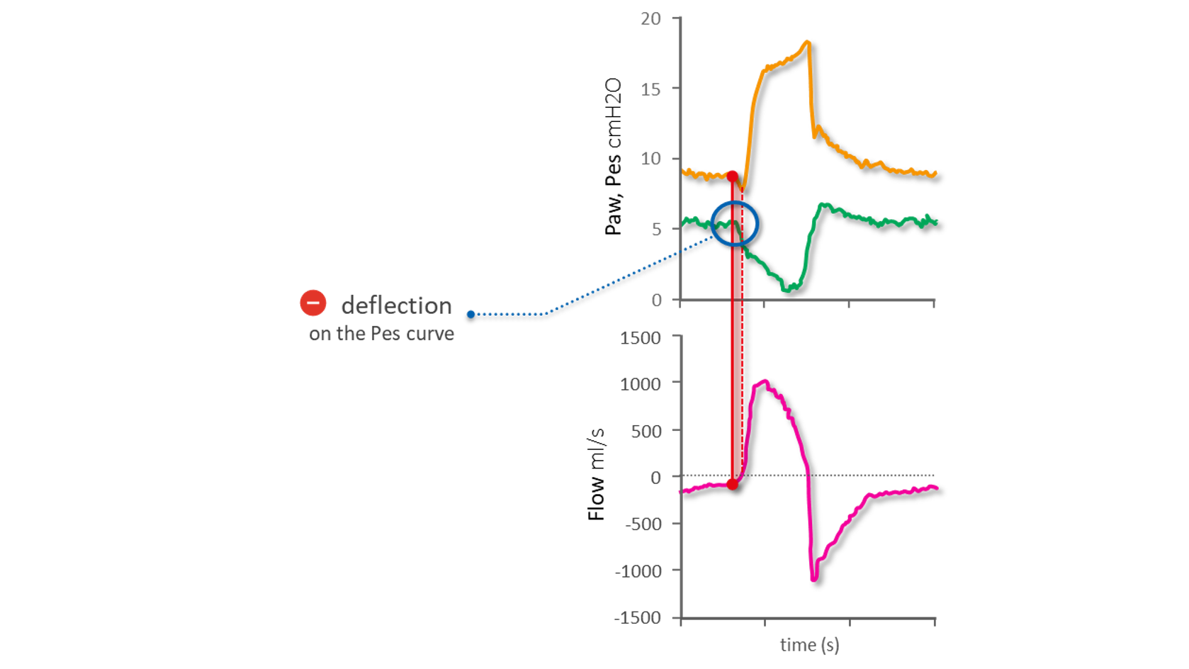 Diagramme mit Druck-, Flow- und Pes-Kurve, die den Beginn der Inspiration anzeigen