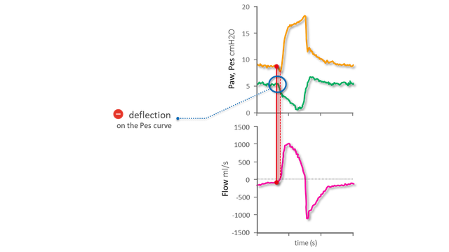 Diagrammi che rappresentano curve di pressione, flusso e Pes in cui è evidente l'inizio dell'inspirazione