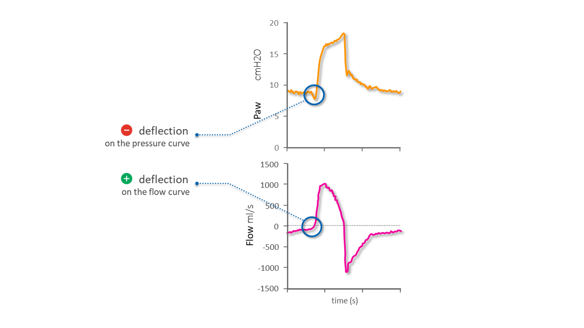 Diagrams representing pressure and flow waveforms showing start of inspiration