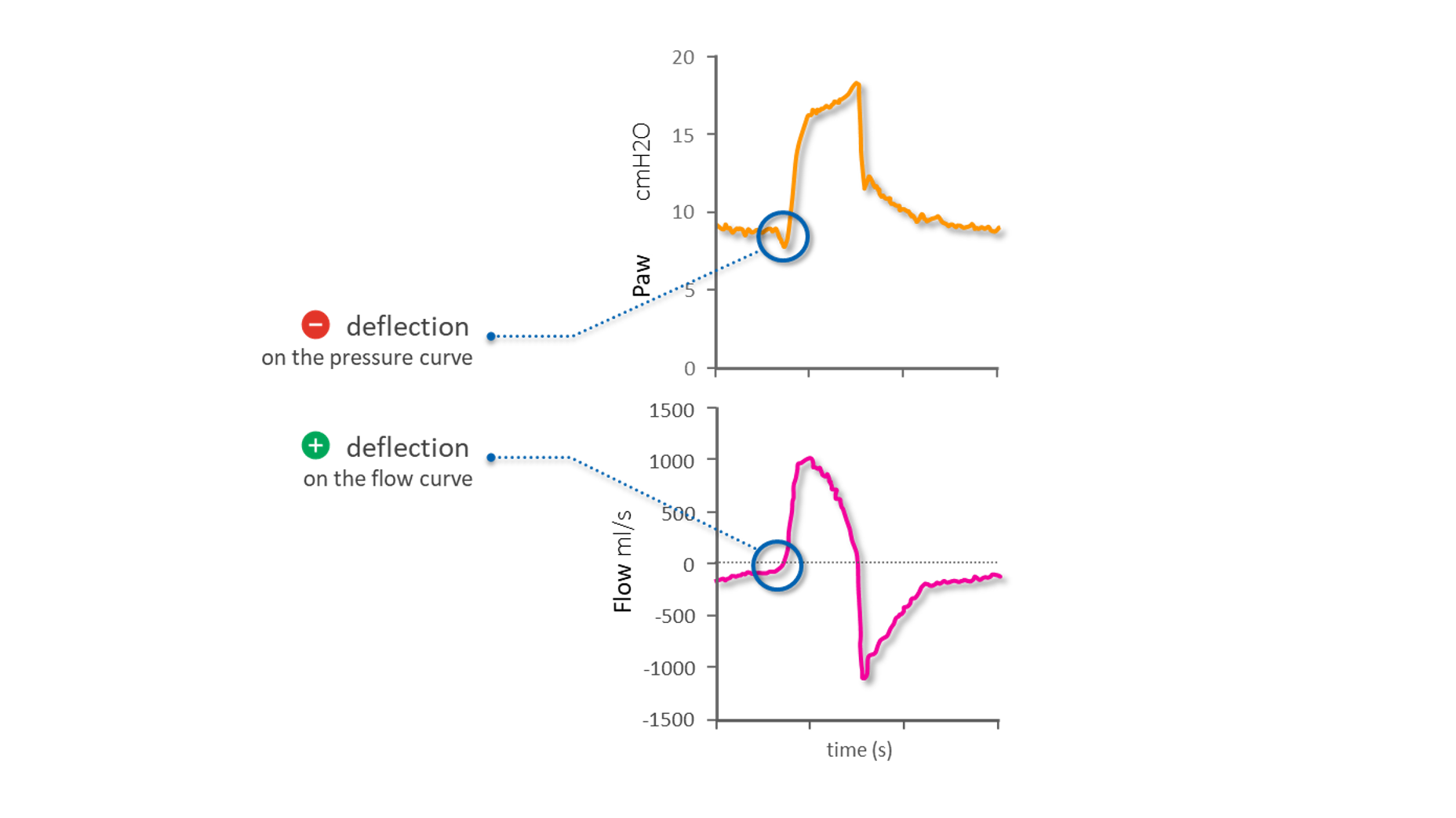 Diagramas de formas de onda de presión y flujo que revelan el inicio de una inspiración