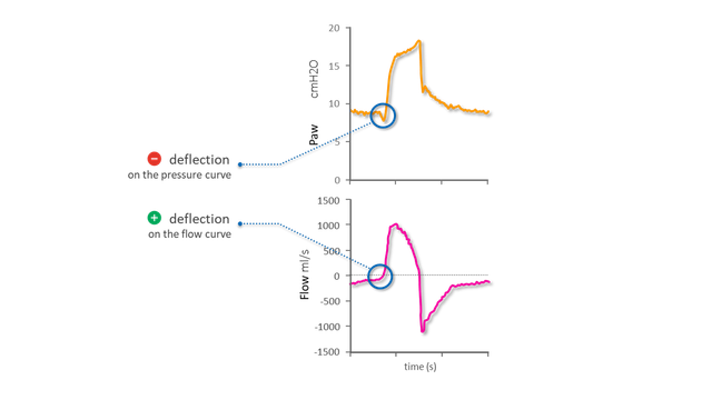 Графики кривых давления и потока, на которых показано начало вдоха