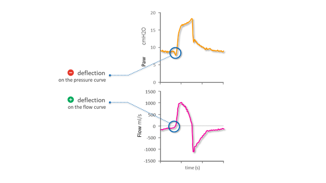 Diagrams representing pressure and flow waveforms showing start of inspiration