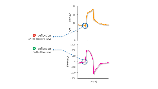 Diagrams representing pressure and flow waveforms showing start of inspiration
