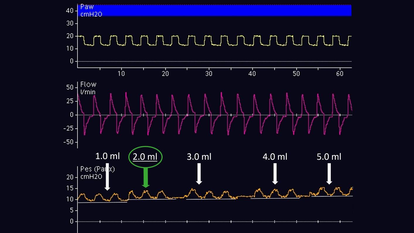 Waveform during balloon inflation