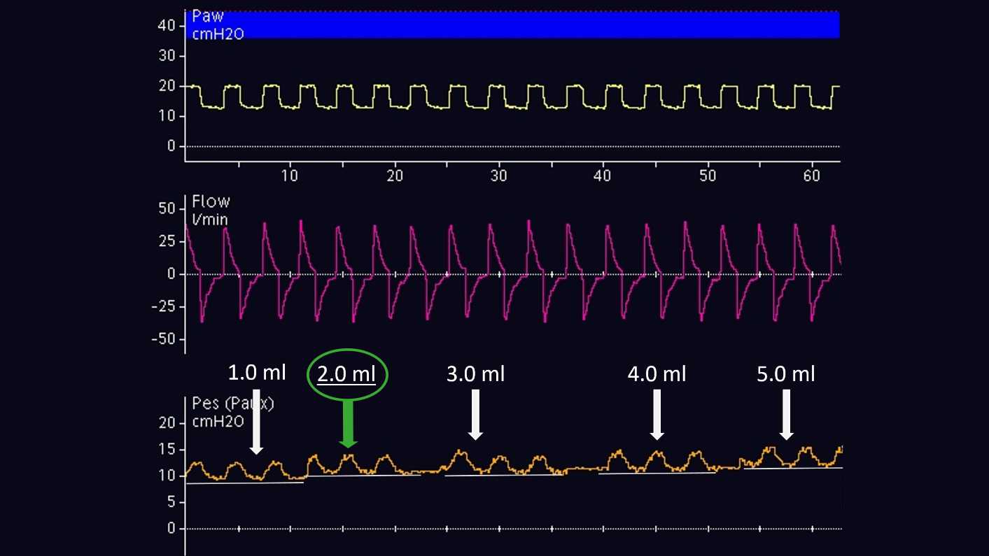 Forme d'ondes lors du gonflage du ballonnet