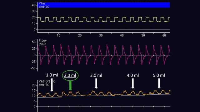 Waveform during balloon inflation